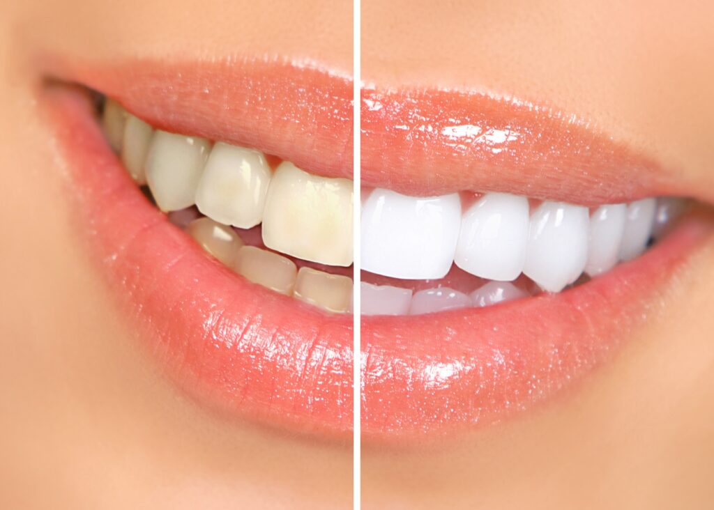 Teeth Whitening in North Ryde: Your Options