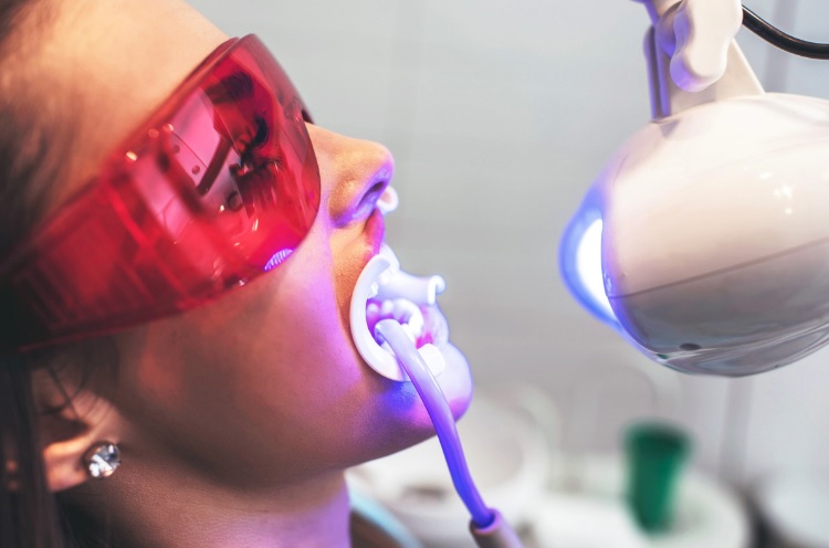 Professional Teeth Whitening: What to Consider